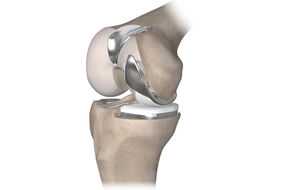 Knie-Teilprothese (Schlittenprothese)